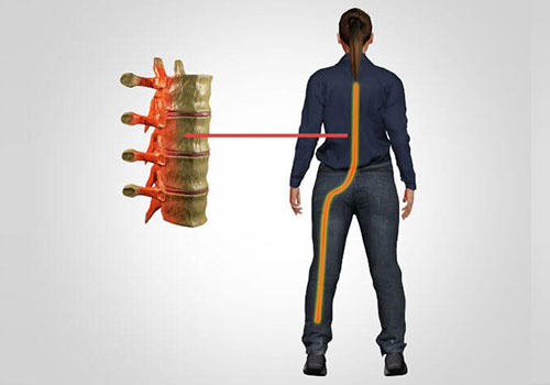 sciatica in Mohebbi wellness